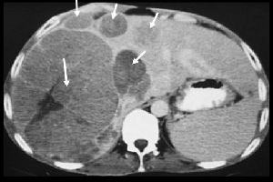 Gambar Hepatoma