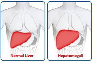 Gambar Hepatomegali