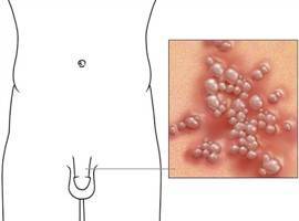 Gambar Herpes Genitalis