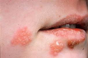 Gambar Herpes Simpleks