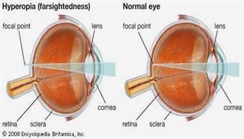 Gambar Hipermetropi