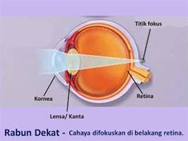 Gambar Hipermetropia Ringan