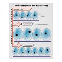 Gambar Hiperplasia