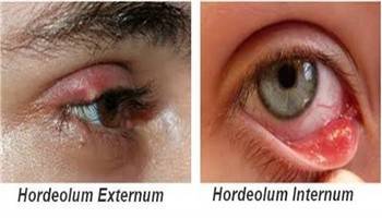 Gambar Hordeolum