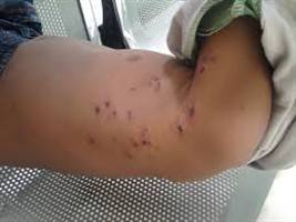 Gambar Impetigo Krustosa