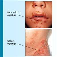 Gambar Impetigo