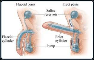 Gambar Impotensi