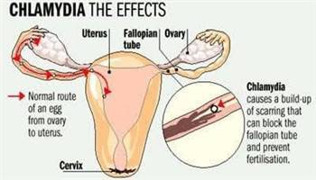 Gambar Infeksi Klamidia