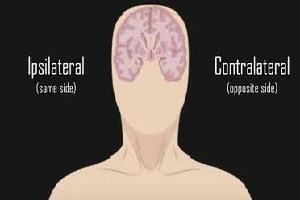 Gambar Ipsilateral