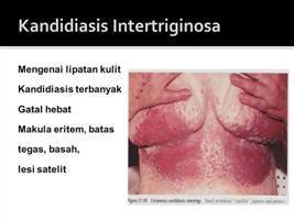 Gambar Kandidiasis Intertriginosa