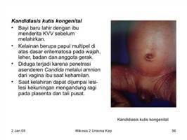 Gambar Kandidiasis Kutis Kongenital