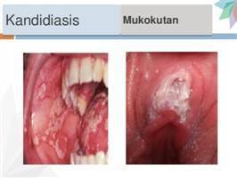 Gambar Kandidiasis Mukokutan