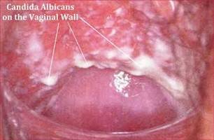 Gambar Kandidiasis Mukosa Genital