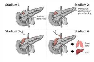 Gambar Kanker Pankreas