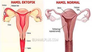 Gambar Kehamilan Ektopik Terganggu