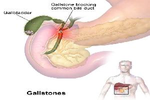 Gambar Kolangitis Asendens