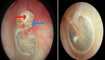 Gambar Kolesteatoma