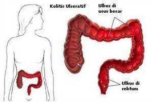 Gambar Kolitis Ulseratif