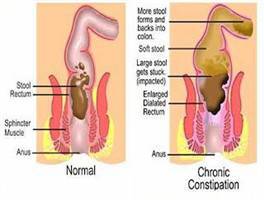 Gambar Konstipasi