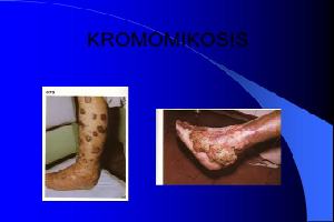 Gambar Kromomikosis