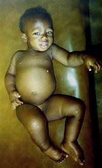 Gambar Kwashiorkor