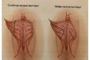 Gambar Labiaplasty