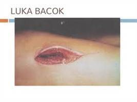 Gambar Luka Bacok