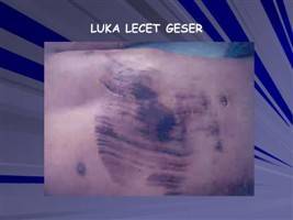 Gambar Luka Lecet Geser