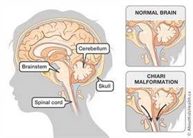 Gambar Malformasi Chiari