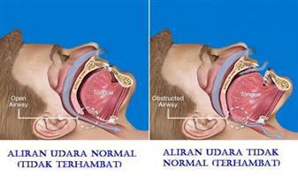 Gambar Mendengkur