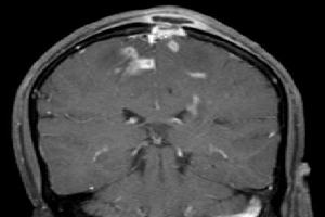 Gambar Meningitis TB