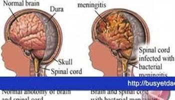 Gambar Meningitis