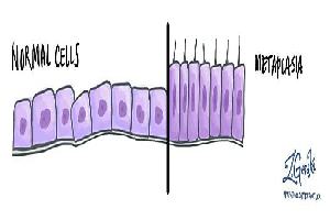 Gambar Metaplasia