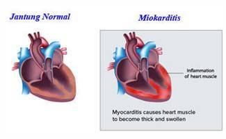 Gambar Miokarditis