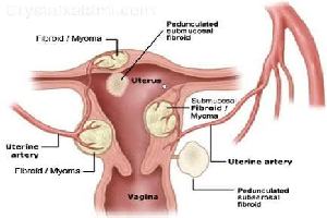 Gambar Mioma Uteri