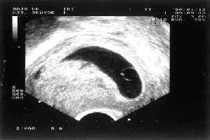 Gambar Missed Abortion