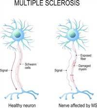 Gambar Multiple Sclerosis