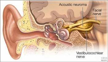 Gambar Neuroma Akustik