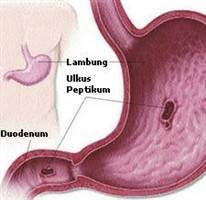 Gambar Obat Ulkus Peptikum