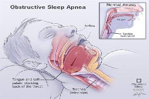 Gambar Obstructive Sleep Apnea