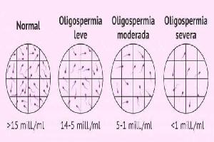 Gambar Oligospermia