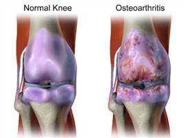 Gambar Osteoartritis