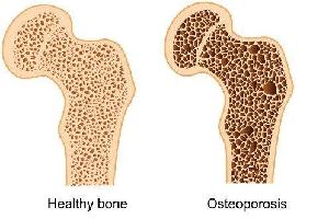 Gambar Osteoporosis