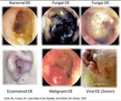 Gambar Otitis Eksterna