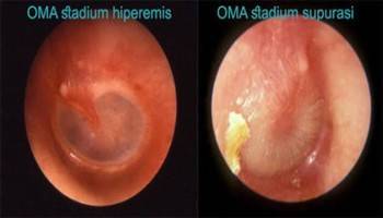 Gambar Otitis Media Akut