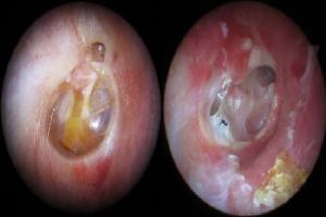 Gambar Otitis Media Supuratif Kronik Benigna