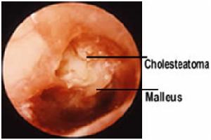 Gambar Otitis Media Supuratif Kronik Maligna