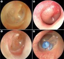 Gambar Otitis Media