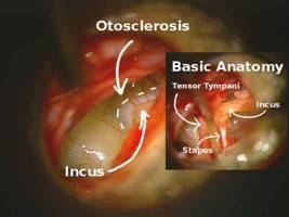 Gambar Otosclerosis