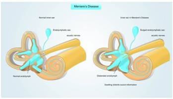 Gambar Penyakit Meniere